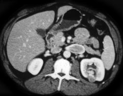 Renal Cell Carcinoma - CTisus CT Scan