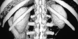 3D Shaded Surface Display of the Kidney - CTisus CT Scan