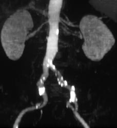 Old MIP Images Showing the Renal Arteries - CTisus CT Scan