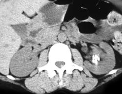 Stones in Left Renal Pelvis - CTisus CT Scan