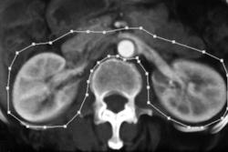 Ct Urography - CTisus CT Scan