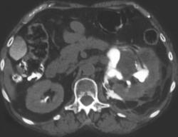 Contrast Is Seen Through Ruptured Renal Pelvis Due to Stone Disease - CTisus CT Scan