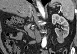 Renal Cell Carcinoma - CTisus CT Scan