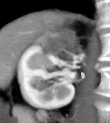 Renal Infarction - CTisus CT Scan