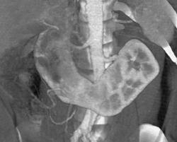 Horseshoe Kidney - CTisus CT Scan