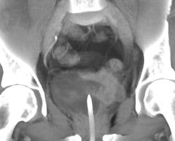 Bladder Cancer - CTisus CT Scan