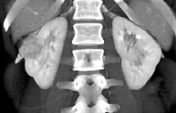 Vascular Renal Cell Carcinoma - CTisus CT Scan