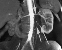 Multiple Renal Arteries - CTisus CT Scan