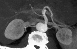 Small Bilateral Renal Arteries - CTisus CT Scan