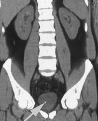 Passed Stone in Bladder - CTisus CT Scan