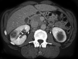 Bilateral Renal Metastases - CTisus CT Scan