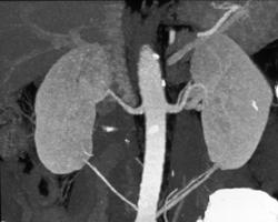 Second Renal Arteries to the Lower Pole of the Kidneys - CTisus CT Scan