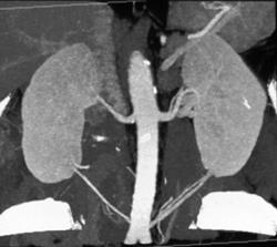 Multiple Renal Arteries - CTisus CT Scan