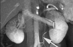 IMA Simulates Accessory Renal Arteries - CTisus CT Scan