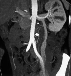 Prominent Left Gonadal Vein - CTisus CT Scan