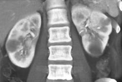 Multiple Renal Metastases - CTisus CT Scan