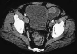 Cancer in A Bladder Diverticulum - CTisus CT Scan