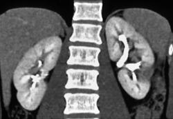 Renal Abscess - CTisus CT Scan