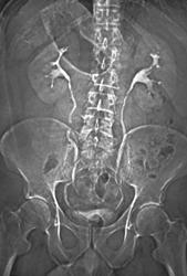 Topograms for Pelvocalyceal System for Renal Donors - CTisus CT Scan