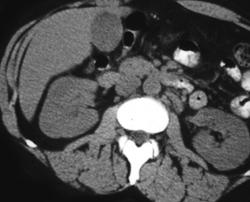 Renal Cell Carcinoma - CTisus CT Scan