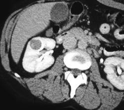 Cystic Renal Cell Carcinoma - CTisus CT Scan