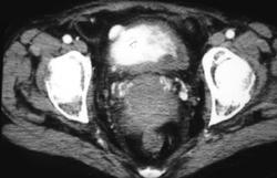 Bladder Cancer - CTisus CT Scan