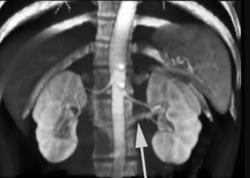 Retroaortic Renal Vein - CTisus CT Scan