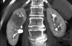 Transitional Cell Carcinoma - CTisus CT Scan