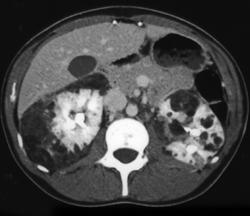 Tuberous Sclerosis - CTisus CT Scan