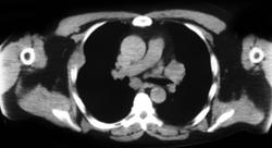 Metastatic Renal Cell Carcinoma to Nodes and Bone - CTisus CT Scan