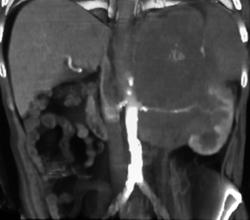 Lymphoma Invades the Kidney - CTisus CT Scan