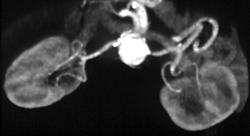 Left Renal Artery Stenosis - CTisus CT Scan