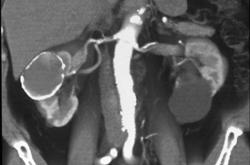 Calcified Renal Cyst - CTisus CT Scan