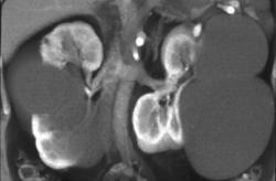 Multiple Renal Cysts - CTisus CT Scan