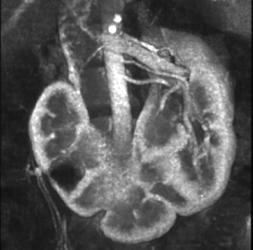 Horseshoe Kidney - CTisus CT Scan