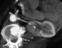 Calcification of Left Renal Artery - CTisus CT Scan