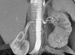 Left Renal Cell Carcinoma - CTisus CT Scan