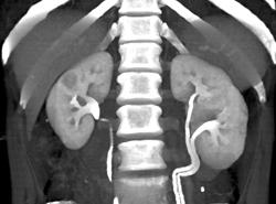 1 Cm Right Renal Cell Carcinoma (hypervascular) - CTisus CT Scan