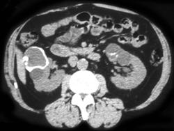 Calcified Renal Mass Bilaterally (no Change Over Time) - CTisus CT Scan