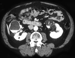 Calcified Renal Lesions- Probably Bosniak Ii-iii Lesions - CTisus CT Scan