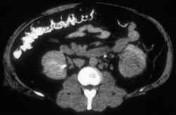 Renal Cell Carcinoma - CTisus CT Scan