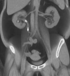 Obstructing Stones in Right Kidney - CTisus CT Scan