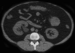 Obstructing Stone in Proximal Right Ureter - CTisus CT Scan