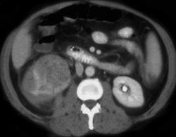 Renal Cell Carcinoma With Perirenal Bleed - CTisus CT Scan