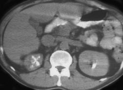 Tuberculosis (TB) With Papillitis - CTisus CT Scan