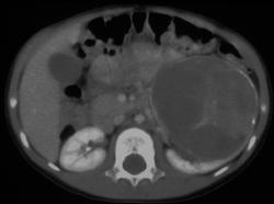 Cystic Renal Cell Carcinoma - CTisus CT Scan