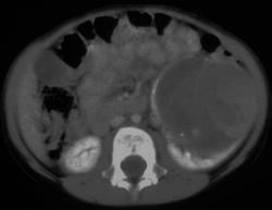 Cystic Renal Cell Carcinoma - CTisus CT Scan