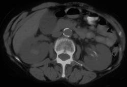 Transitional Cell Carcinoma With Hemorrhage - CTisus CT Scan