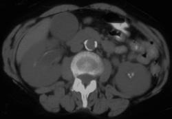 Calcification in Transitional Cell Carcinoma - CTisus CT Scan