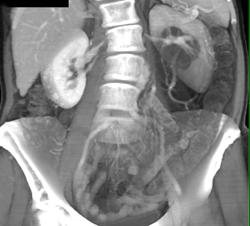 Large Renal Angiomyolipoma That Simulates A Liposarcoma of the Retroperitoneum - CTisus CT Scan